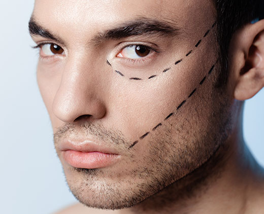 The man on the face is marked with guides before surgery filling