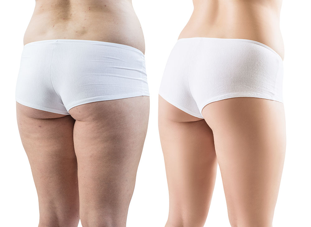 Female buttocks before and after sport and treatment. Isolated on white